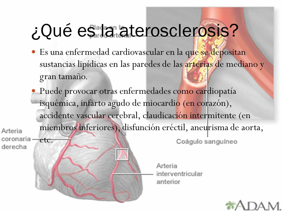 aterosclerosis disfunción eréctil